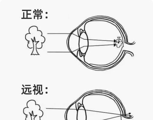 小孩远视眼镜训练方法视频教程？